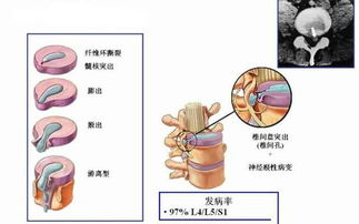 运动与预防：如何避免腰间盘突出问题？,运动与预防：如何避免腰间盘突出问题？,第2张