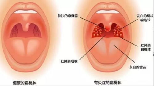 喉咙卡鱼刺的紧急处理方法,喉咙卡鱼刺的紧急处理方法,第2张